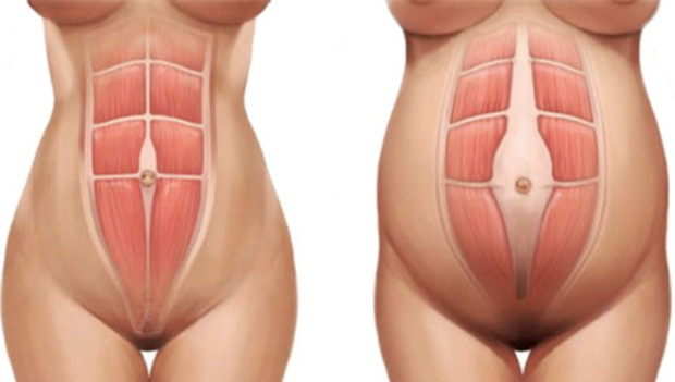 Diastase-abdominal.jpg