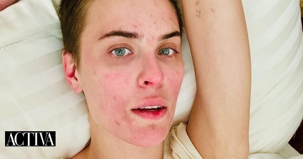 Tallulah Willis assume problema de acne contra o qual luta há anos