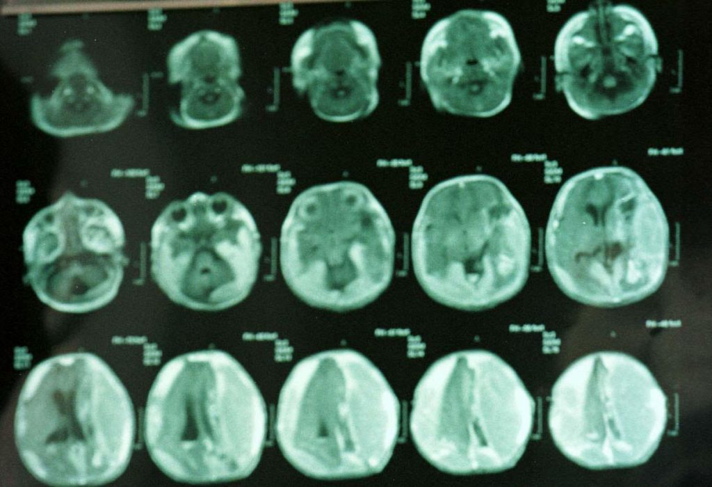 Menino de 12 anos vê confirmado direito a recusar quimioterapia