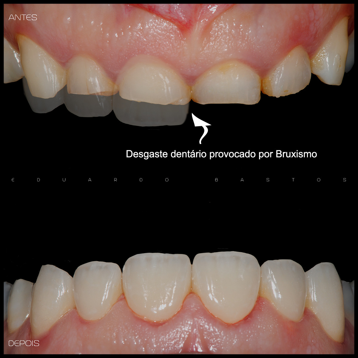 Bruxismo do sono - saiba como evitar as dores e desgastes dos dentes