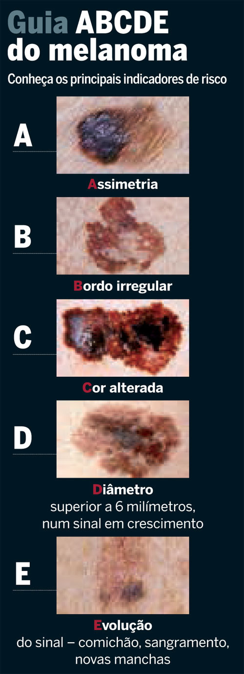 Melanoma