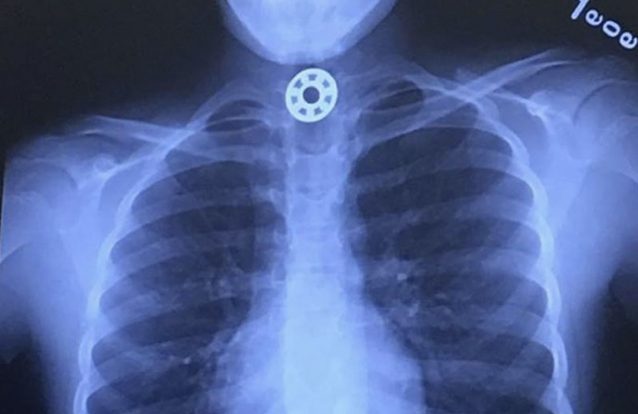 Alerta para perigo de engasgamento com Figdet Spinners torna-se viral