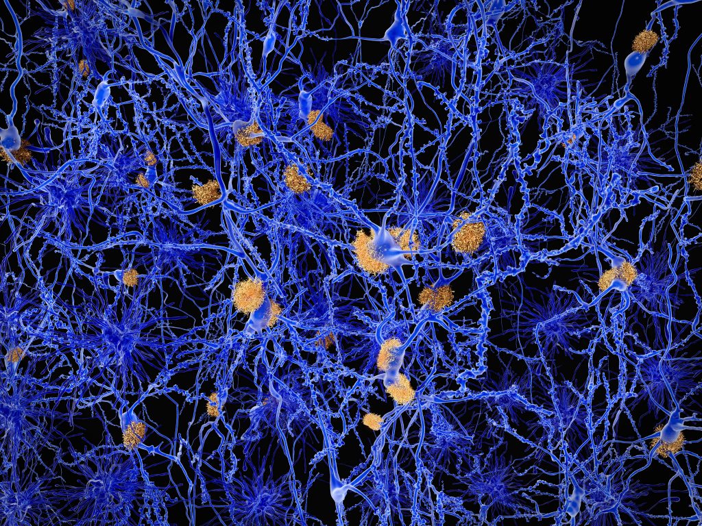 Há uma teoria alternativa para o que provoca a doença de Alzheimer (e uma nova possibilidade de cura)