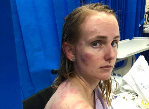 Imagens impressionantes das graves lesões que uma jovem sofreu a tentar proteger bebé de enormes pedras granizo tornam-se virais