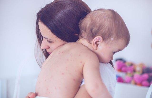 O sarampo veio para ficar?