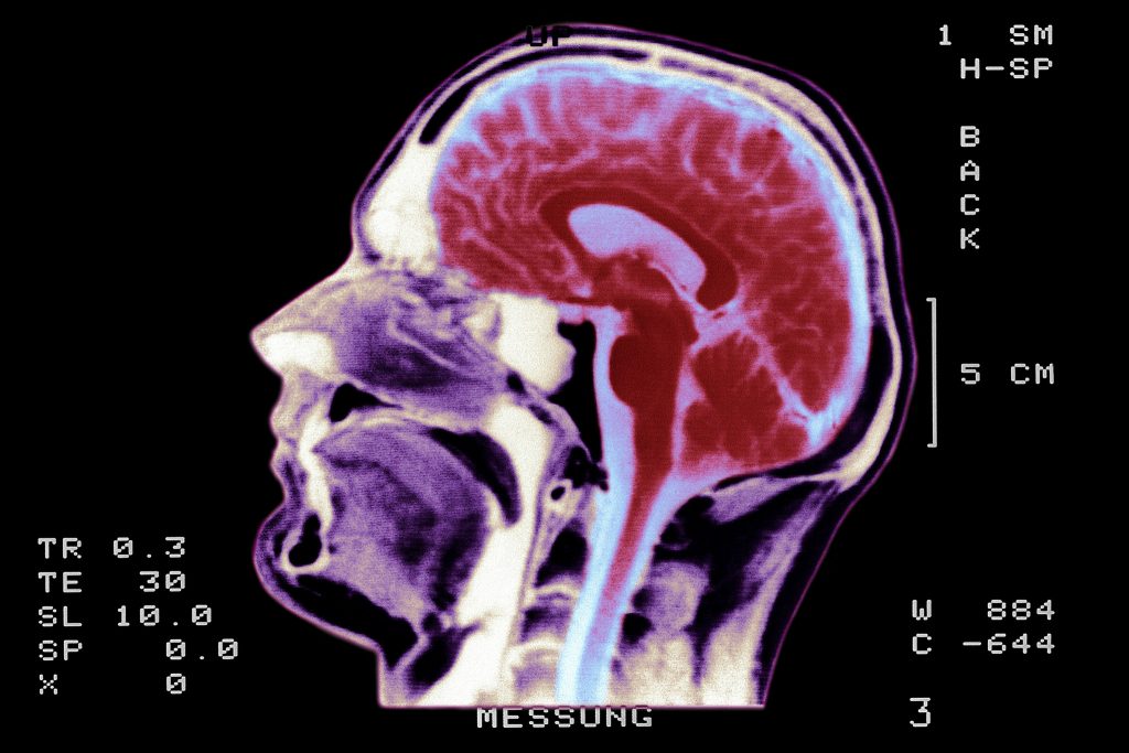 Pobres até no crescimento cerebral