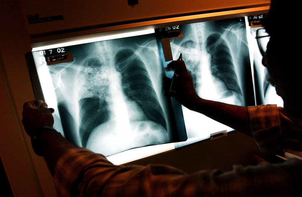 Tuberculose resistente aos medicamentos ameaça décadas de progressos, alertam cientistas