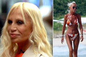 Donatella Versace  Botox, Cirurgia plastica, Cirurgias