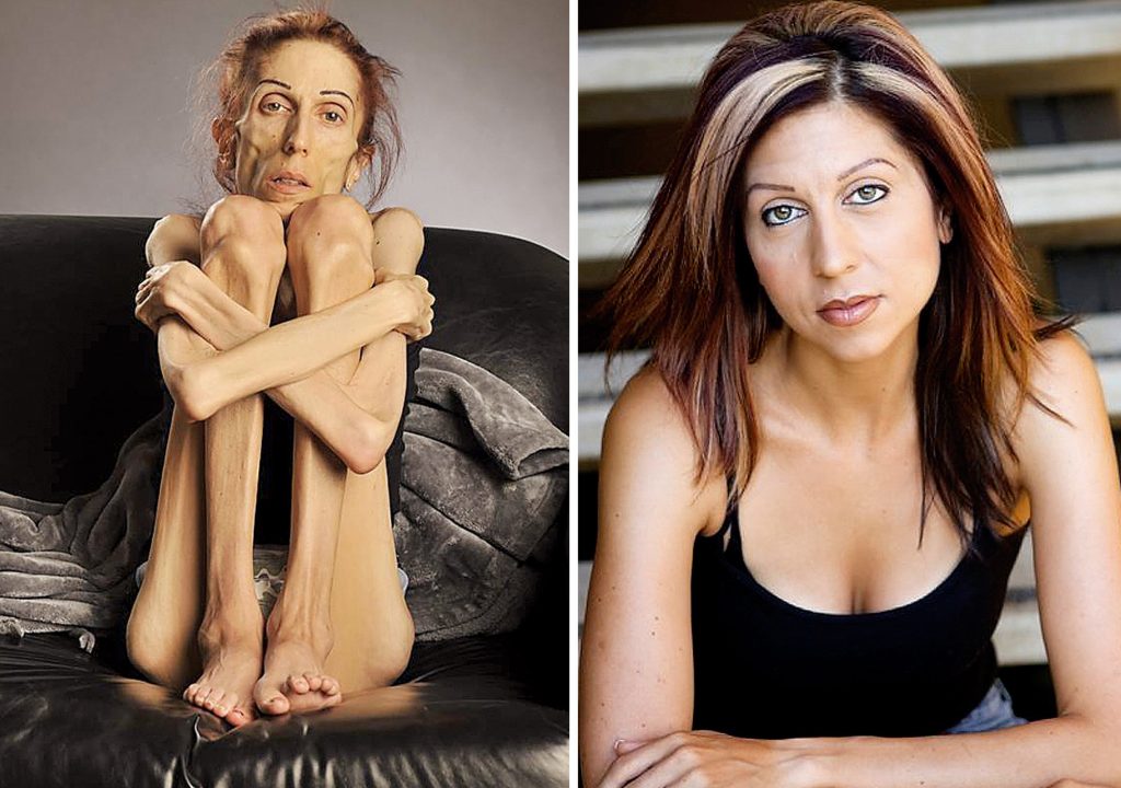 A clínica de luxo no Algarve onde se trata a anorexia