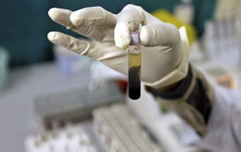 Análise de sangue pode prever reaparecimento de cancro da mama