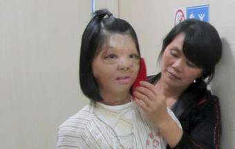 Jovem chinesa mostra rosto reconstruído a partir de enxerto no peito 2