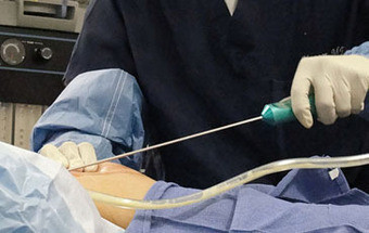 Lipoaspiração: Um ano depois, a gordura está de volta
