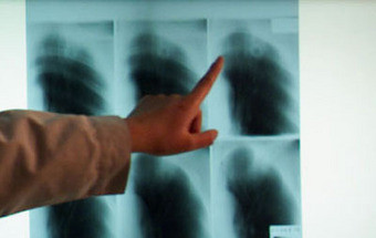 Médico japonês com tuberculose examinou mais de 600 doentes