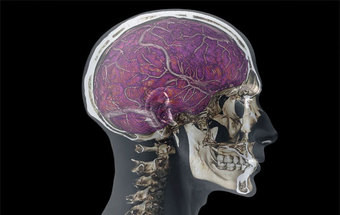 Novo tratamento com ultrassons representa avanços na cura do Alzheimer