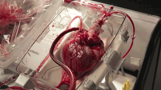 Heart_transplant_boxx519.gif