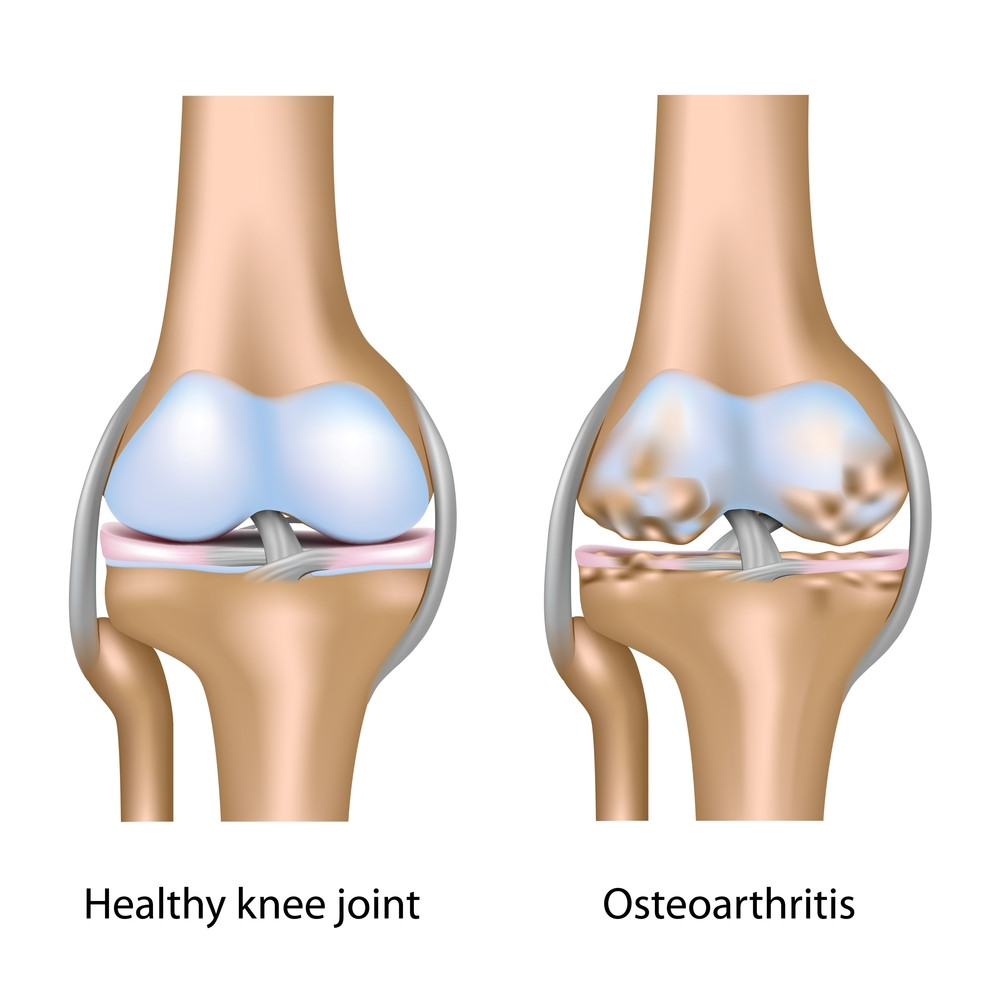 Arthritis_knee.jpg