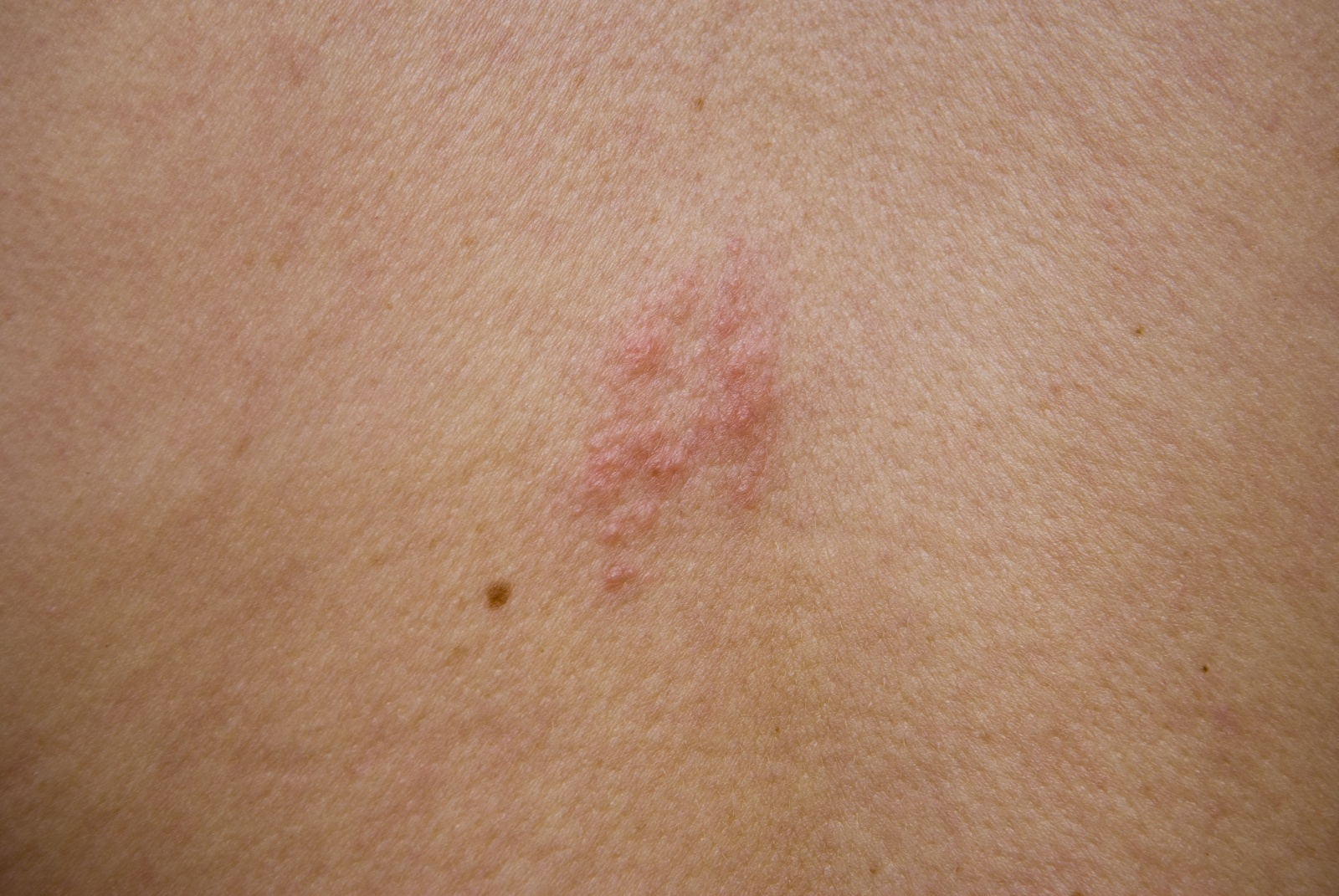 pictures of shingles        
        <figure class=