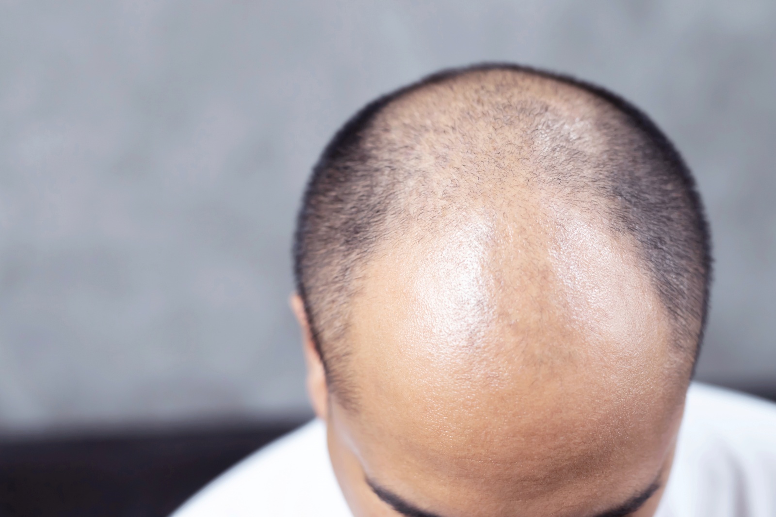 O cabelo parou de crescer? Veja 4 fatores que podem estar causando