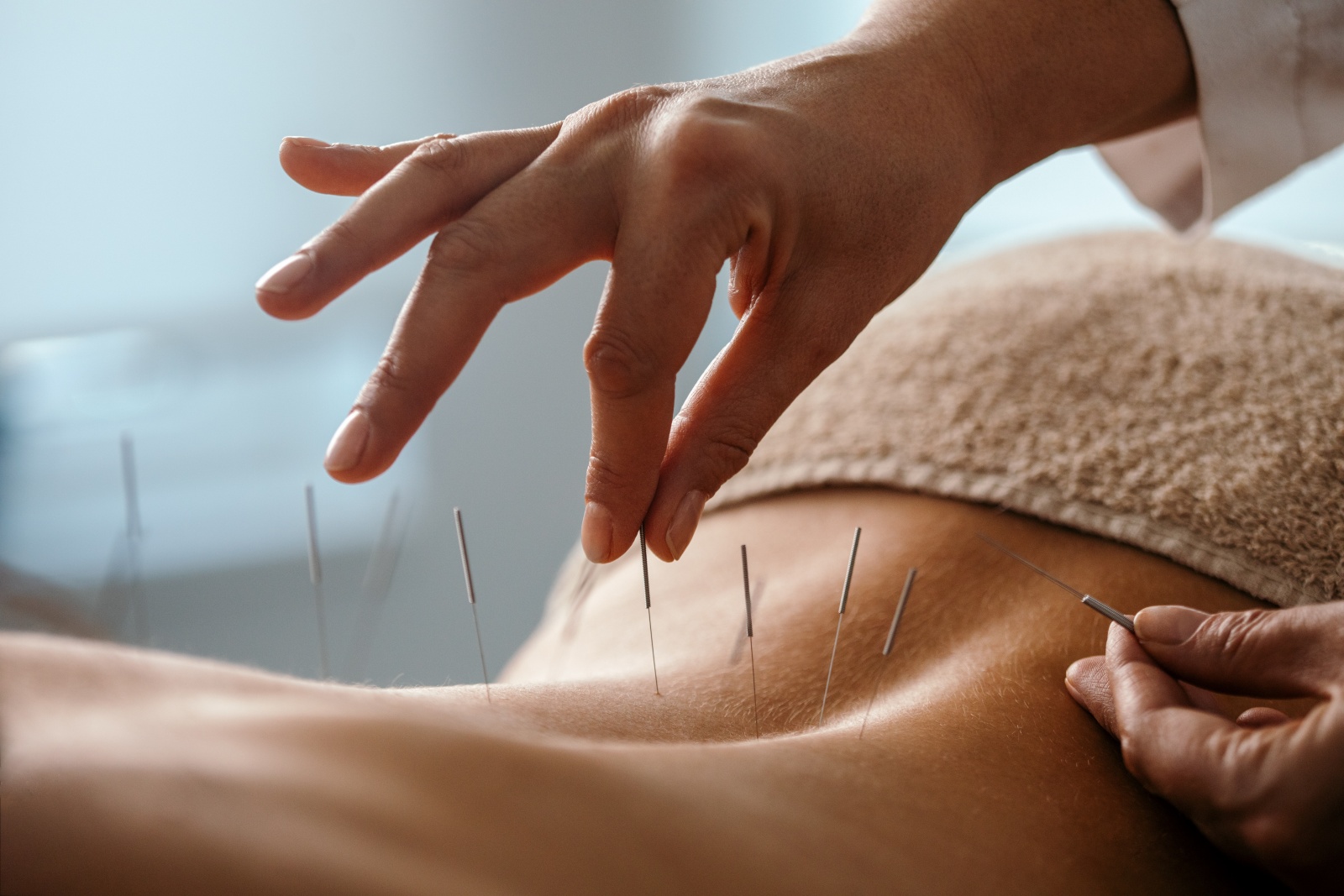 Visão | A acupunctura não tem benefícios para a saúde, conclui novo estudo