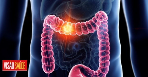 O cancro do intestino está a aumentar abaixo dos 50 anos. A que devemos estar atentos?